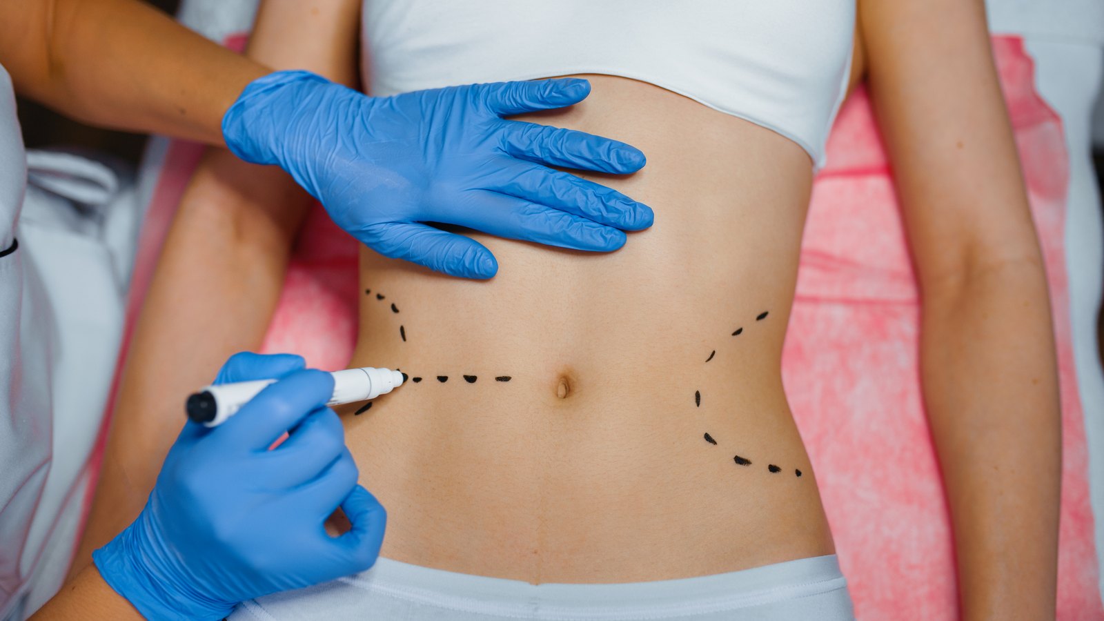 Manos enguantadas marcan con rotulador el abdomen de una paciente, la zona de donde se extrae la grasa
