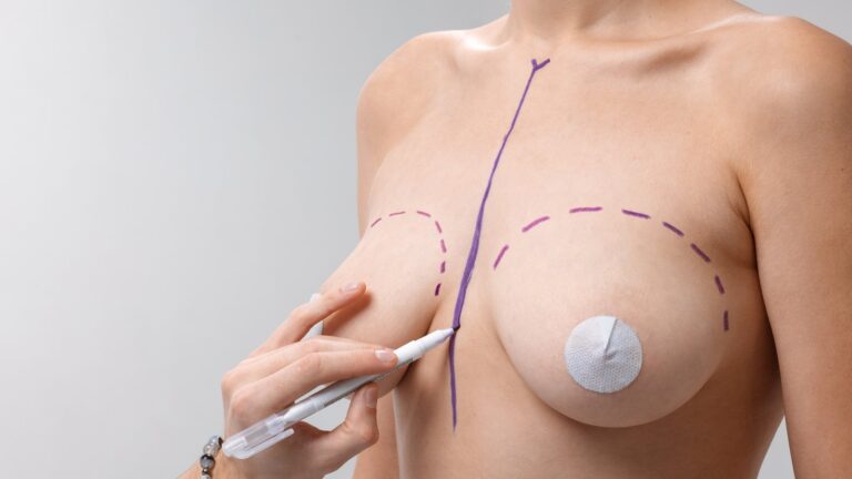 Marcas de una mastopexia dibujadas sobre el pecho: la línea central y el contorno de cada mama